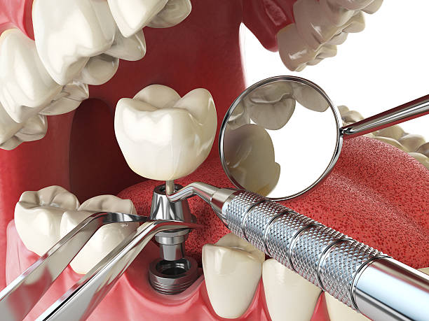 Best Emergency Tooth Extraction in Manchester, MI